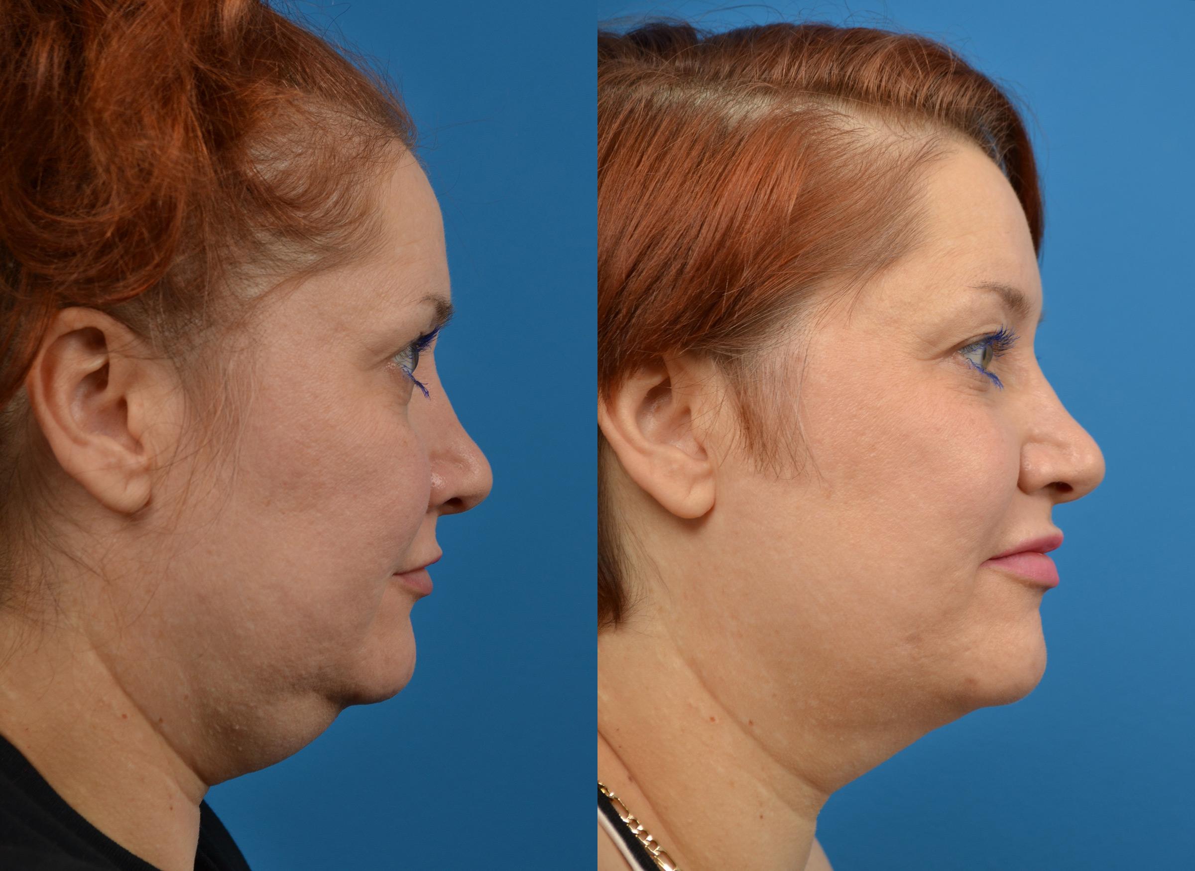 Kybella Photos | Melbourne, FL | Patient 58553